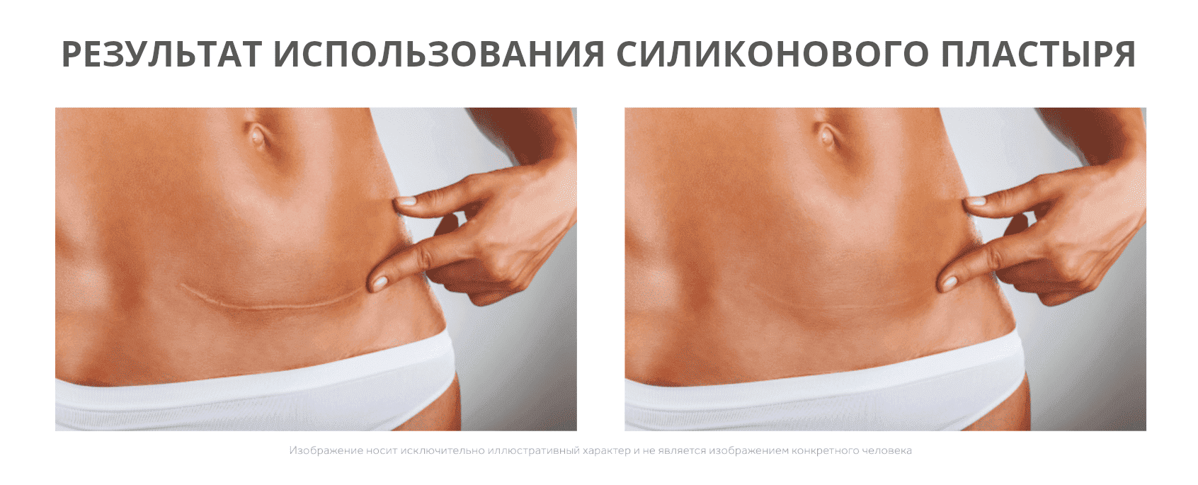 Силиконовый пластырь