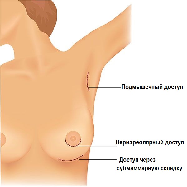 виды хирургических доступов при увеличении груди