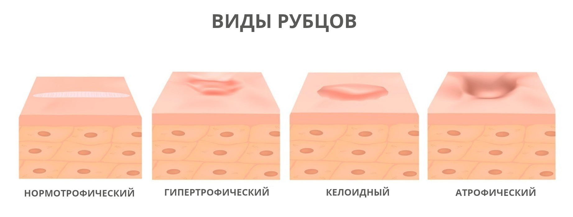 Швы после увеличения груди: где находятся, какими бывают, когда можно  снимать, правила ухода и возможные осложнения