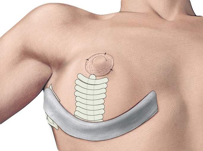 Якорная подтяжка груди - окончание операции