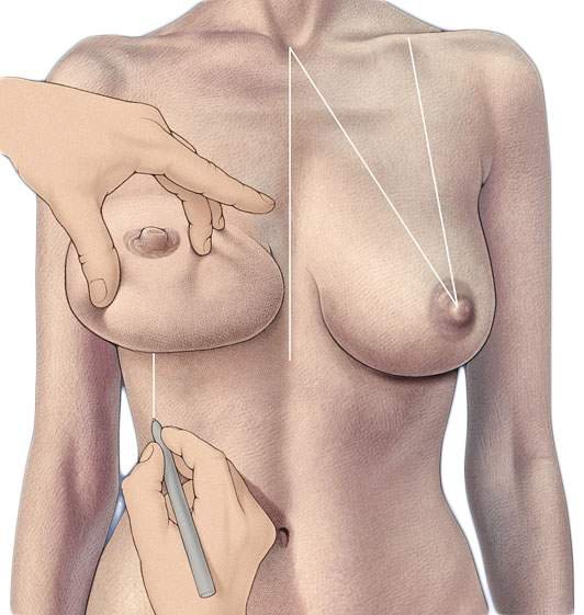 Якорная подтяжка груди - маркировка