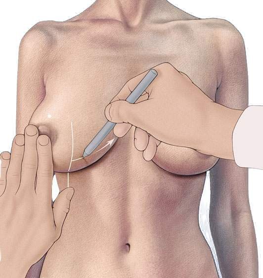Якорная подтяжка груди - маркировка