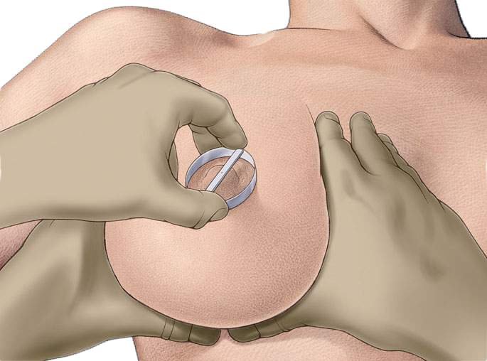 Якорная подтяжка груди - выполнение разреза